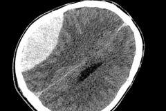epidural haematoma