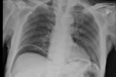 pneumoperitoneum_cxr