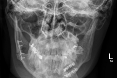 #mandible2