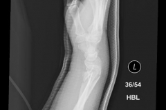 segmental_forearm2