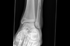 cyst2