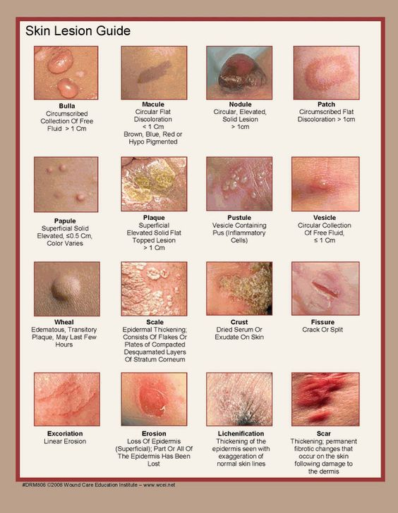 How to describe a skin lesion!